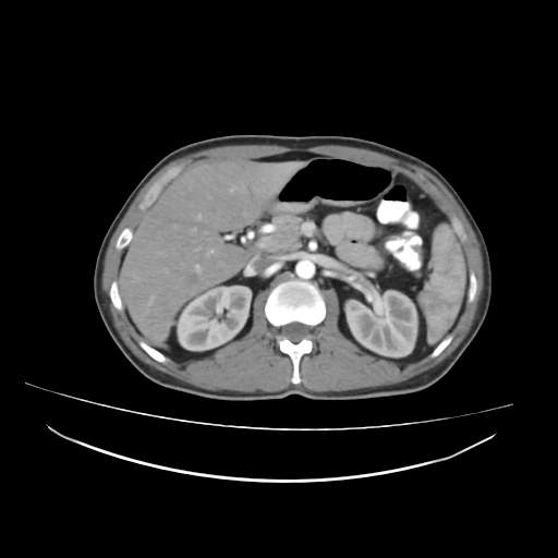 Cecal carcinoma with local lymphadenopathy (Radiopaedia 31428-32240 A 15).jpg