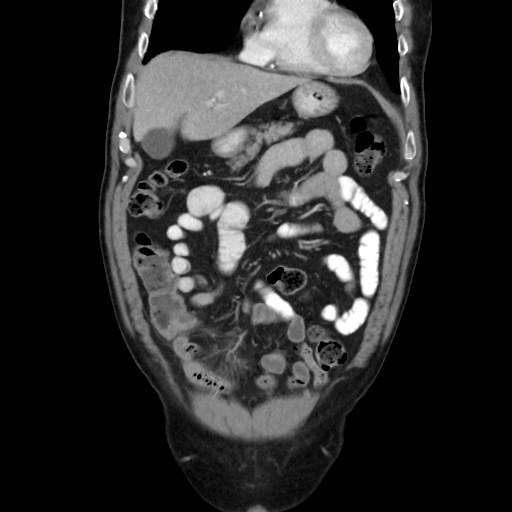 Cecal mass causing appendicitis (Radiopaedia 59207-66531 B 15).jpg