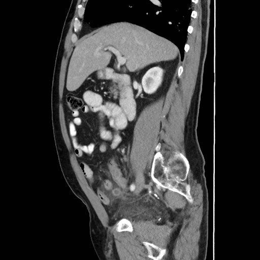 Cecal mass causing appendicitis (Radiopaedia 59207-66531 C 24).jpg