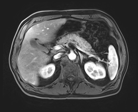 Cecal mass causing appendicitis (Radiopaedia 59207-66532 H 47).jpg