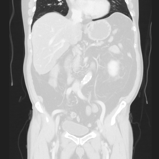 Cecal volvulus (Radiopaedia 75378-86620 Coronal lung window 72).jpg