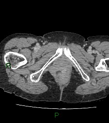 Cecal volvulus (Radiopaedia 86741-102900 A 143).jpg
