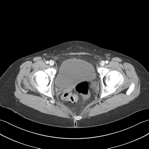 File:Cecum hernia through the foramen of Winslow (Radiopaedia 46634-51112 A 69).png