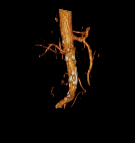 File:Celiacomesenteric trunk (Radiopaedia 67660-77071 VR C+ arterial phase 1).jpg