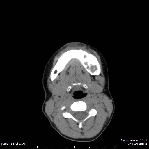 Central giant cell granuloma (Radiopaedia 45612-49754 Axial non-contrast 8).jpg