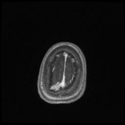 Central neurocytoma (Radiopaedia 30220-30842 Axial T1 C+ 140).jpg