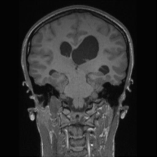 Central neurocytoma (Radiopaedia 37664-39557 Coronal T1 39).png
