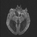 Central neurocytoma (Radiopaedia 56690-63469 Axial DWI 46).jpg