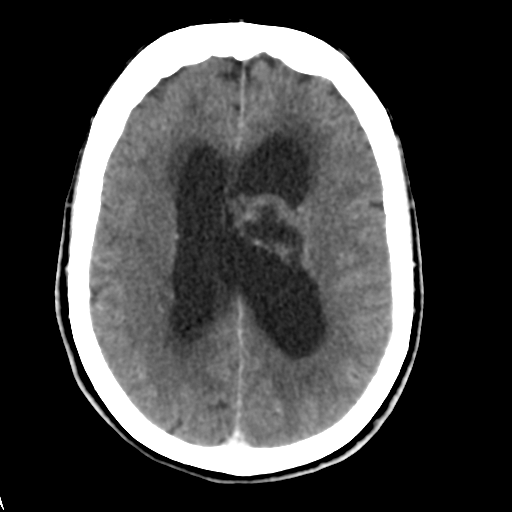 Central neurocytoma (Radiopaedia 65317-74346 Axial C+ delayed 31).png