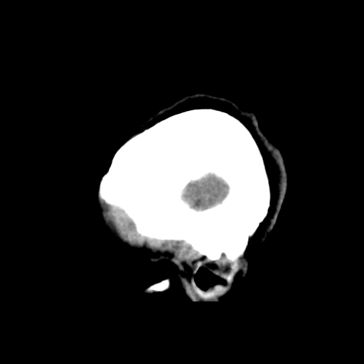 File:Central neurocytoma (Radiopaedia 65317-74346 C 7).png