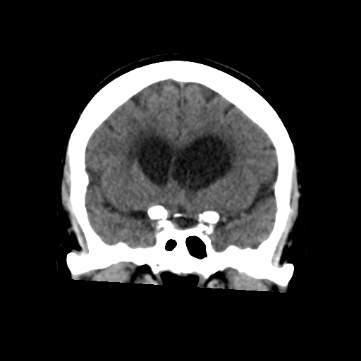 File:Central neurocytoma (Radiopaedia 65317-74346 Coronal non-contrast 23).png
