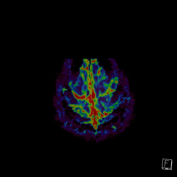 Central neurocytoma (Radiopaedia 84497-99872 Axial Perfusion 19).jpg