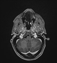 Central neurocytoma (Radiopaedia 84497-99872 Axial T1 C+ 29).jpg
