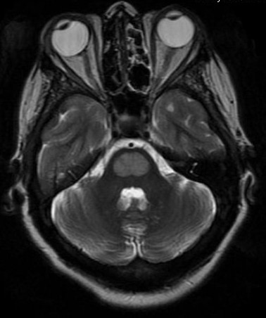 File:Central pontine myelinolysis (Radiopaedia 11286-11650 Axial T2 1).jpg