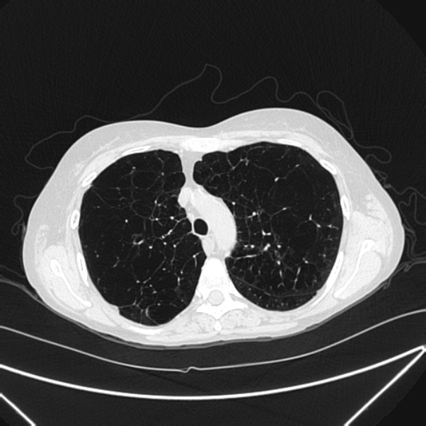 Centrilobular pulmonary emphysema (Radiopaedia 24495-24789 Axial lung window 29).jpg