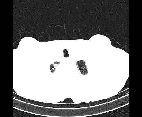 Centrilobular pulmonary emphysema (Radiopaedia 62468-70718 Axial lung window 2).jpg