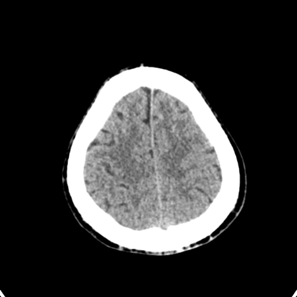 Cerebellar abscess secondary to mastoiditis (Radiopaedia 26284-26412 Axial non-contrast 136).jpg