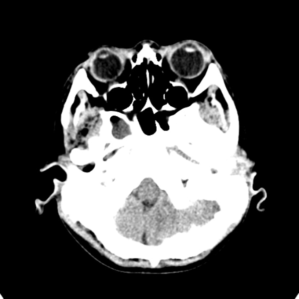 Cerebellar abscess secondary to mastoiditis (Radiopaedia 26284-26412 Axial non-contrast 22).jpg