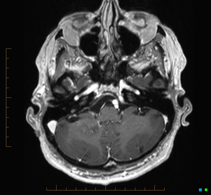 Cerebellar gangliocytoma (Radiopaedia 65377-74422 Axial T1 C+ 20).jpg