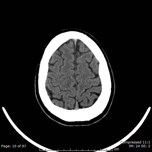 Cerebellar hemangioblastoma (Radiopaedia 52360-58258 Axial non-contrast 10).jpg