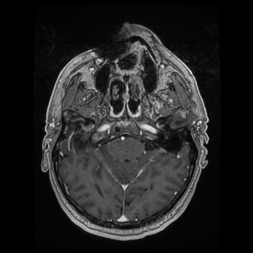 Cerebellar metastasis of pulmonary adenocarcinoma, cavernous venous malformation, and developmental venous anomaly (Radiopaedia 85827-101661 Axial T1 C+ 35).jpg