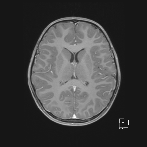 Cerebellar stroke (Radiopaedia 32202-33150 Axial T1 C+ 43).png