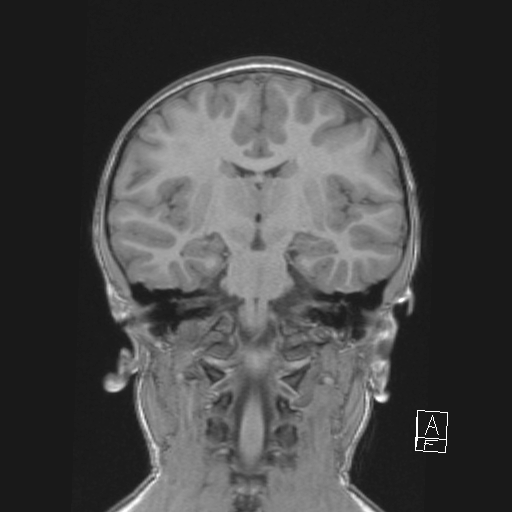Cerebellar stroke (Radiopaedia 32202-33150 Coronal T1 32).png