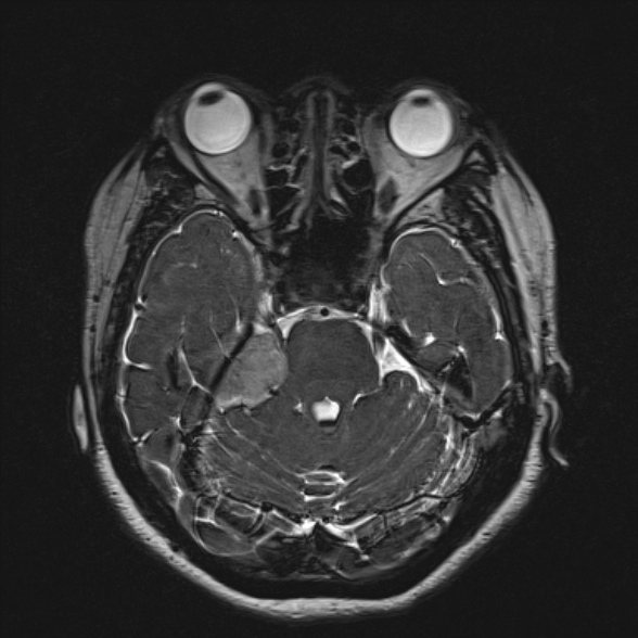File:Cerebellopontine angle meningioma (Radiopaedia 53561-59591 Axial 3D volume T2 74).jpg