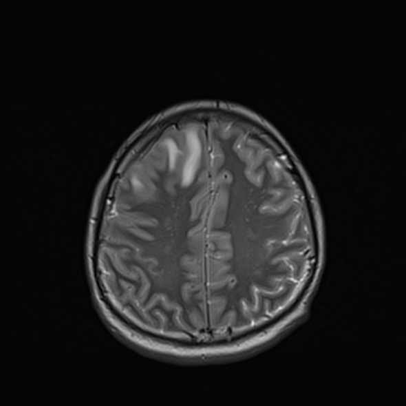 Cerebral abscess (Radiopaedia 24212-24478 Axial T2 46).jpg