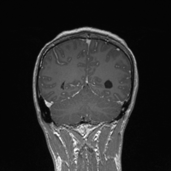 File:Cerebral abscess (Radiopaedia 24212-24478 Coronal T1 C+ 153).jpg