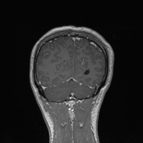 Cerebral abscess (Radiopaedia 24212-24478 Coronal T1 C+ 166).jpg