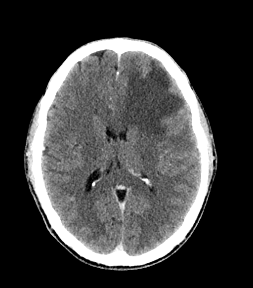 Cerebral abscess (Radiopaedia 57774-64741 Axial C+ delayed 39).png