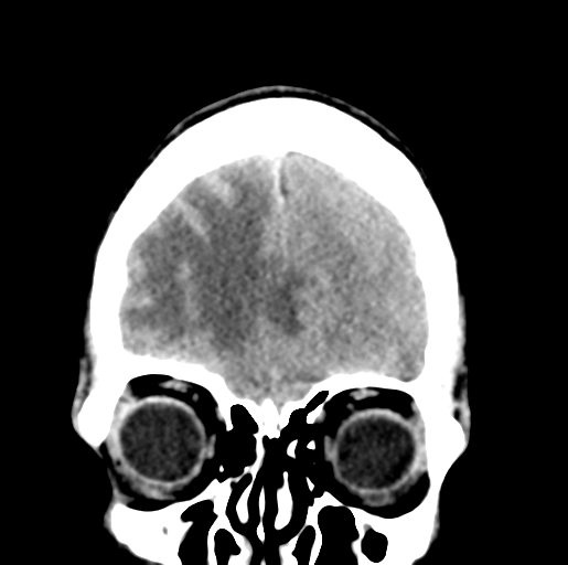 File:Cerebral abscess (Radiopaedia 60342-68008 Coronal non-contrast 11).png