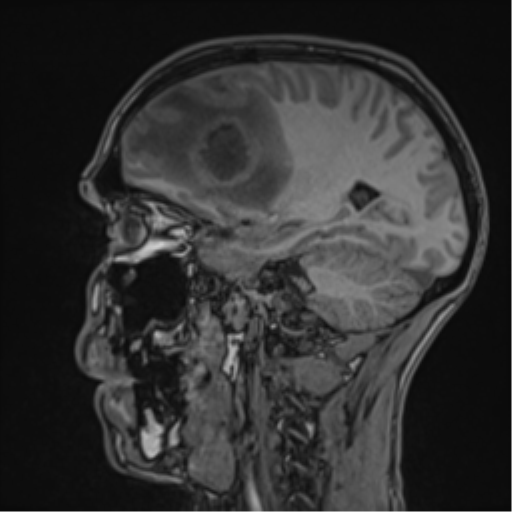 Cerebral abscess (Radiopaedia 60342-68009 Sagittal T1 37).png