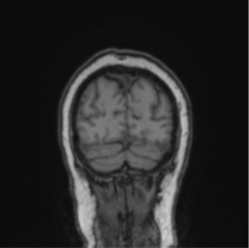 Cerebral abscess from pulmonary arteriovenous malformation (Radiopaedia 86275-102291 Coronal T1 15).png