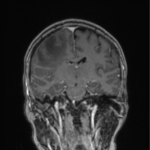 Cerebral abscess from pulmonary arteriovenous malformation (Radiopaedia 86275-102291 L 45).png