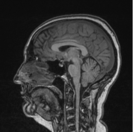 Cerebral abscess from pulmonary arteriovenous malformation (Radiopaedia 86275-102291 Sagittal T1 53).png