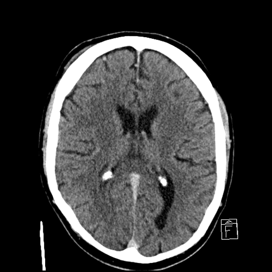 File:Cerebral abscess with ventriculitis (Radiopaedia 78965-91877 A 27).jpg