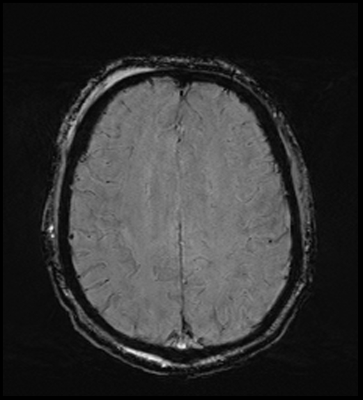 Cerebral abscess with ventriculitis (Radiopaedia 78965-91878 Axial SWI 37).jpg