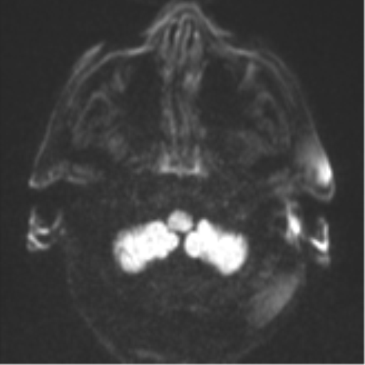 Cerebral abscesses- medically managed (Radiopaedia 45183-49179 Axial DWI 32).png
