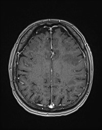 Cerebral amyloid angiopathy-related inflammation (Radiopaedia 58270-65377 Axial T1 C+ fat sat 102).jpg