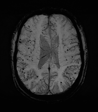 Cerebral amyloid angiopathy (Radiopaedia 46082-50433 Axial SWI MIP 50).png