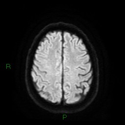 Cerebral amyloid angiopathy (Radiopaedia 77506-89664 Axial DWI 22).jpg