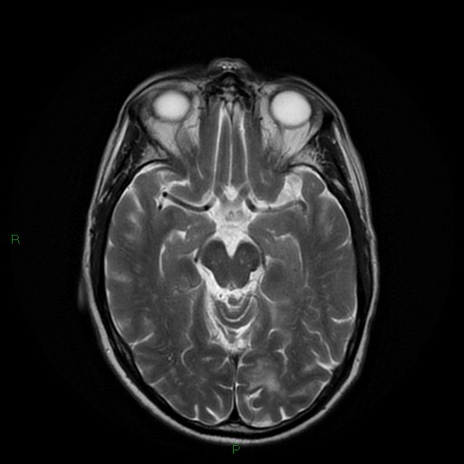File:Cerebral amyloid angiopathy (Radiopaedia 77506-89664 Axial T2 12).jpg