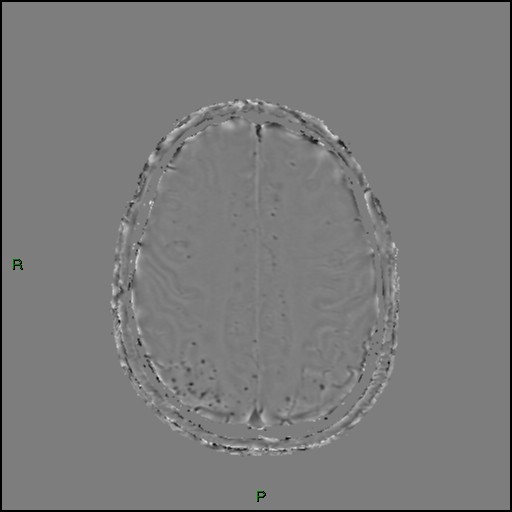 Cerebral amyloid angiopathy (Radiopaedia 77506-89664 H 75).jpg