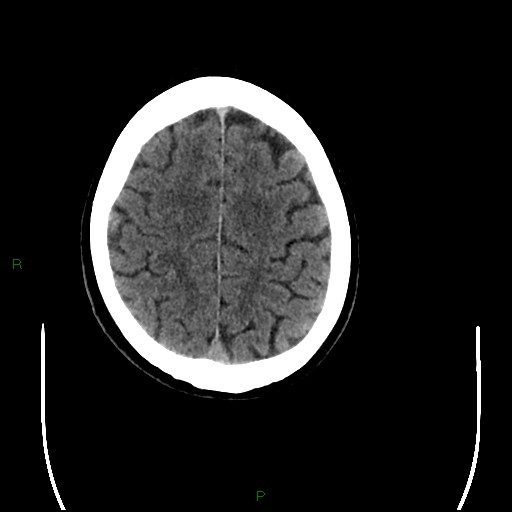 Cerebral amyloid angiopathy (Radiopaedia 77506-89665 Axial non-contrast 87).jpg