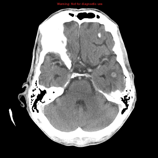 File:Cerebral and orbital tuberculomas (Radiopaedia 13308-13310 B 10).jpg