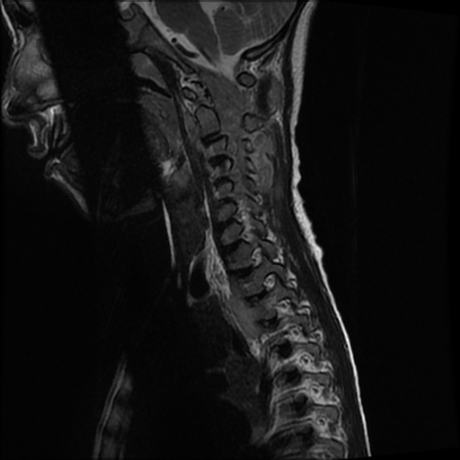 File:Cerebral and spinal tuberculosis (Radiopaedia 90489-107838 Sagittal 9).jpg