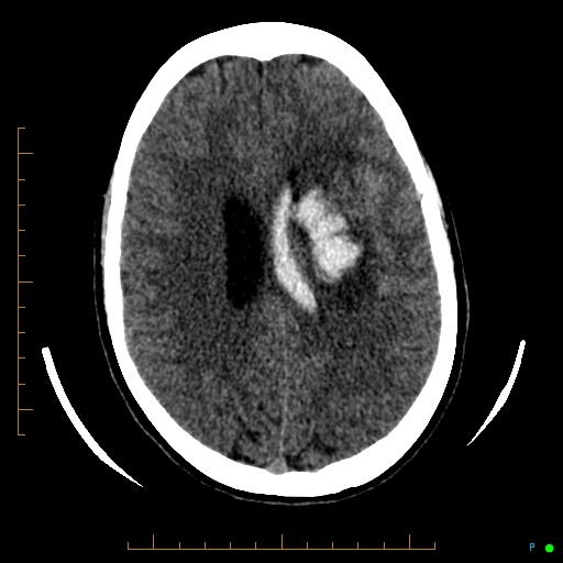 Cerebral arteriovenous malformation (AVM) (Radiopaedia 78162-90706 Axial non-contrast 42).jpg
