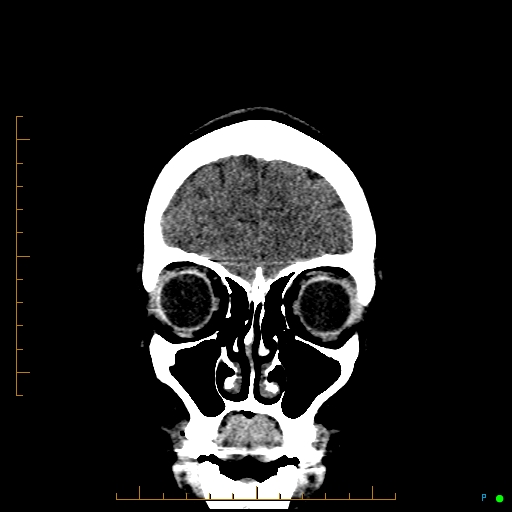Cerebral arteriovenous malformation (AVM) (Radiopaedia 78162-90706 Coronal non-contrast 17).jpg